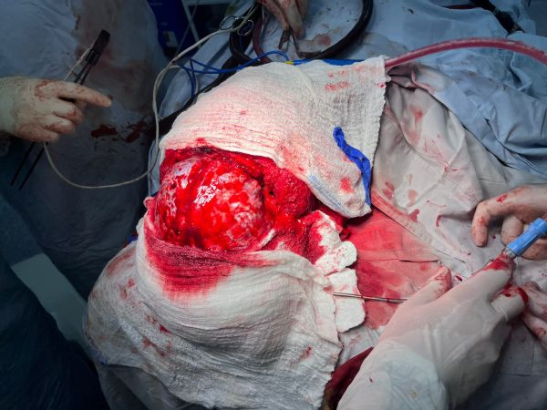 Neurosurgeon Juan Mario Franco performing craniotomy on a patient.